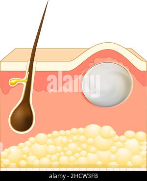 Wen, kyste sébacé, une forme de kyste trichilemmal.Kystes épidermoïdes ou pilaires.Coupe transversale de couches de peau avec follicule pileux et stéatocystome.Vecteur Illustration de Vecteur