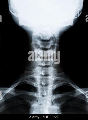 Image radiographique de la colonne cervicale du cou isolée sur fond noir Banque D'Images