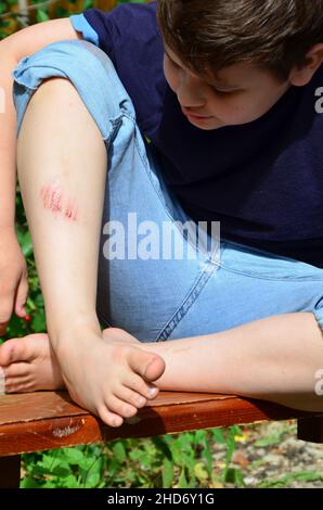 Gros plan sur le genou du jeune enfant blessé après qu'il est tombé sur la chaussée, la jambe du garçon fait mal. Ecchymoses, rayures après les promenades estivales ou les sports. Oint anesthésique Banque D'Images