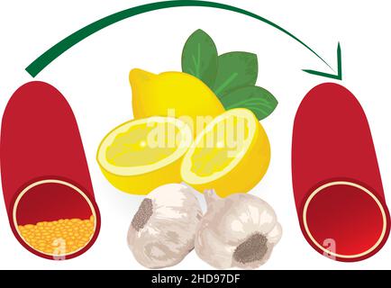 Transformer le niveau élevé de plaque athérosclérotique dans les vaisseaux sanguins en niveau normal avec un repas sain comme le citron et l'ail Illustration de Vecteur