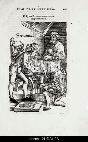 L'illustration au 16th siècle de la chirurgie et des opérations chirurgicales au Moyen-âge : l'amputation de la jambe.Des livres médiévaux d'Octavius Horatianus an Banque D'Images