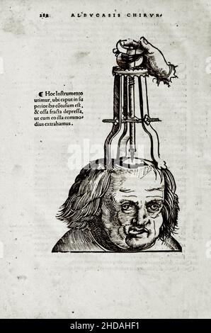 L'illustration au 16th siècle de la chirurgie et des opérations chirurgicales au Moyen-âge: La trépanation du crâne.Des livres médiévaux d'Octavius Ho Banque D'Images