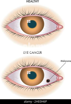 L'illustration médicale montre un œil sain par rapport à un œil affecté par le mélanome. Illustration de Vecteur