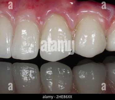 Gros plan d'un ensemble de dents en céramique sur fond noir Banque D'Images