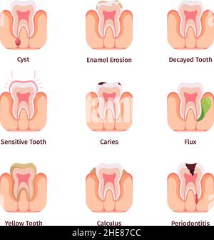 Problèmes dentaires.Les différentes bactéries orales dents dessins mauvais plombages communs Garish vecteur infographiques médicaux concept illustrations Illustration de Vecteur