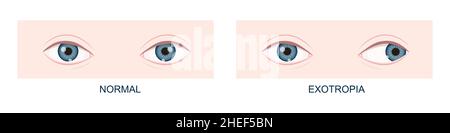 Exotropia.Strabisme horizontal avant et après la chirurgie.Mauvais alignement des yeux, condition croisée.Les yeux humains sont en bonne santé et avec une position de regard vers l'extérieur.Double vision.Illustration de dessin animé vectoriel Illustration de Vecteur