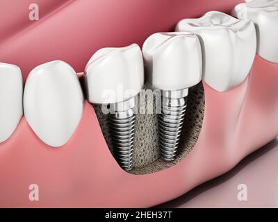 3D illustration de deux implants dentaires sur la mâchoire inférieure. Banque D'Images