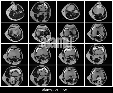 Imagerie par résonance magnétique, images MRT du genou.arthrite psoriasique aiguë, arthrose .excès de liquide synovial dans et autour de l'articulation gauche du genou Banque D'Images