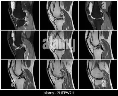 Imagerie par résonance magnétique, images MRT du genou.arthrite psoriasique aiguë, arthrose .excès de liquide synovial dans et autour de l'articulation gauche du genou Banque D'Images