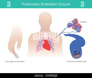 L'embolie pulmonaire se produit.Une condition anormale de faible niveau d'oxygène dans le sang, cause de l'embolie pulmonaire, se produit. Illustration de Vecteur