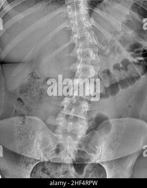 Rachis lombaire radiographie, en projection antéro-postérieure, d'un patient atteint de scoliose Banque D'Images