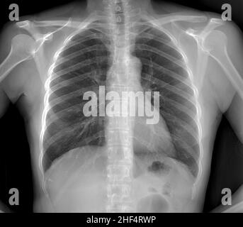 Radiographie thoracique pour le contrôle de la pneumonie chez un patient post-covid Banque D'Images