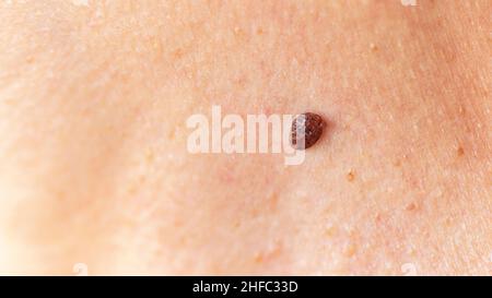 Gros taupe ou nevus sur peau mûre gros plan macro photographie avec espace de copie.Lésion bénigne sur la peau d'une femme.Concept de traitement des maladies de la peau. Banque D'Images