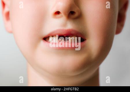 L'enfant sourit, ses dents de lait avant sont tombées et les molaires ont commencé à croître. Dentisterie pédiatrique. Banque D'Images