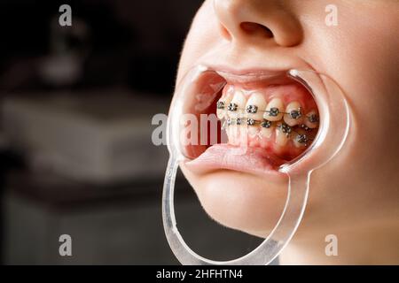 Une jeune femme avec des bretelles métalliques est examinée par un orthodontiste.Correction de la morsure des dents dans la clinique dentaire.Concept de dents saines. Banque D'Images