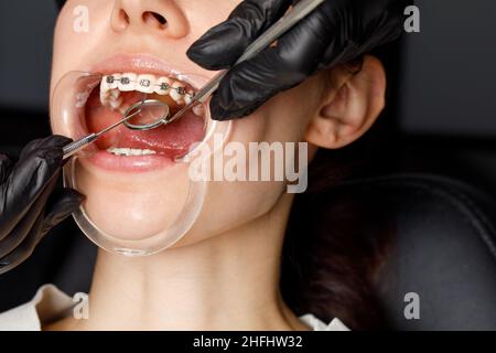 Une jeune femme avec des bretelles métalliques est examinée par un orthodontiste.Correction de la morsure des dents dans la clinique dentaire.Concept de dents saines. Banque D'Images