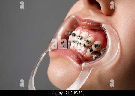 Une jeune femme avec des bretelles métalliques est examinée par un orthodontiste.Correction de la morsure des dents dans la clinique dentaire.Concept de dents saines. Banque D'Images