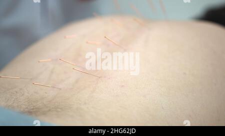 Gros plan d'une personne qui reçoit un traitement d'acupuncture au spa.Patient allongé sur un lit avec des aiguilles en acier dans son dos pendant la procédure d'acupunctu Banque D'Images