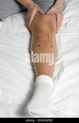 Femme massante suture postopératoire après une fracture de jambe.Concept de réadaptation et de récupération après chirurgie sur le genou cassé.Gros plan Banque D'Images
