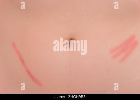 Cicatrisation de la peau de l'abdomen du corps après le retrait de l'appendicite chirurgie conséquences de la chirurgie, gros plan. Banque D'Images