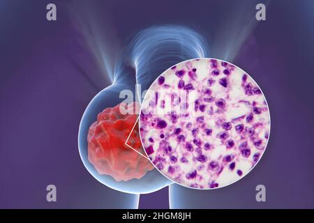 Cancer du testicule, illustration et micrographe léger Banque D'Images