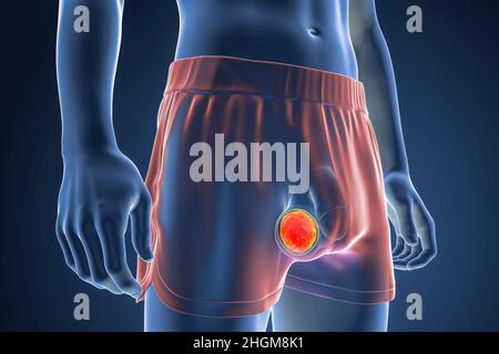 Cancer du testicule, illustration Banque D'Images