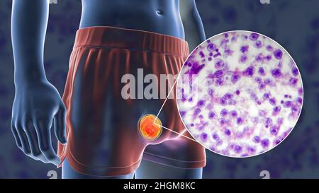 Cancer du testicule, illustration et micrographe léger Banque D'Images
