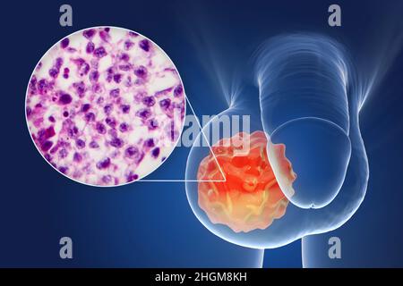 Cancer du testicule, illustration et micrographe léger Banque D'Images