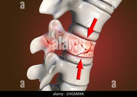 Fracture de compression de la colonne vertébrale, illustration Banque D'Images