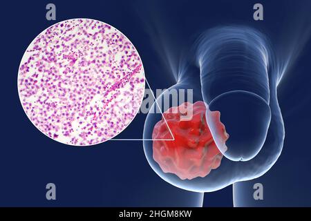 Cancer du testicule, illustration et micrographe léger Banque D'Images