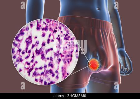 Cancer du testicule, illustration et micrographe léger Banque D'Images