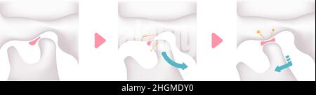 Illustration de la cause des troubles temporomandibulaires (TMD) Illustration de Vecteur
