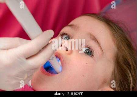 Ultraviolet en dentisterie, le dentiste tient un dispositif à la lumière ultraviolette pour sceller rapidement le remplissage dans la dent de l'enfant, la fille garde sa bouche Banque D'Images