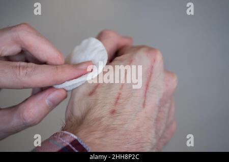 Homme essayant de traiter les rayures de chat avec un tampon de coton et du peroxyde d'hydrogène Banque D'Images