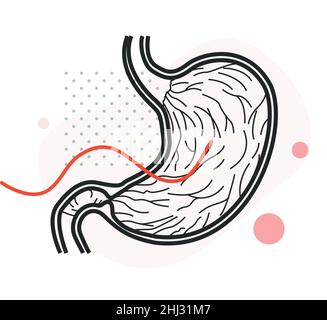 Ulcère peptique - mal d'estomac - Illustration comme fichier EPS 10 Illustration de Vecteur