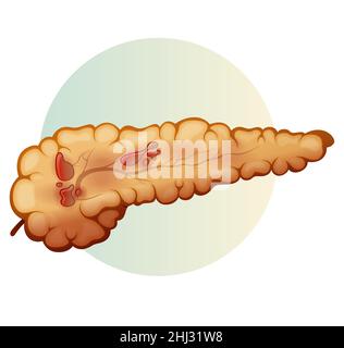 Pancréas - pancréatite aiguë - Illustration du stock comme fichier EPS 10 Illustration de Vecteur