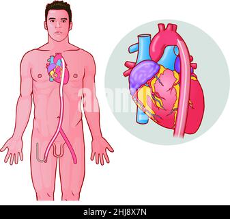 L'un des trois diagrammes d'art médical d'une série montrant comment un dispositif de thérapie par ballonnet intra-aortique (IABP) est joint sujets de biologie éducative Banque D'Images