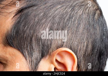 Vue rapprochée du profil d'un homme Dandruff dans les cheveux et le cuir chevelu Banque D'Images