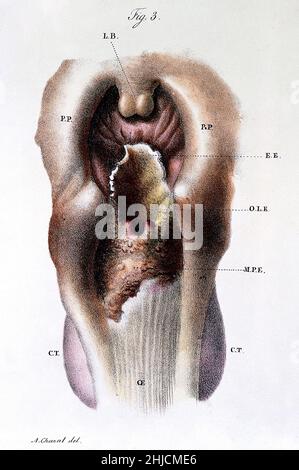 Illustration d'un larynx malade.De 'Anatomie pathologique du corps humain, édition 5th.'J. Cruveilhier, publié 1829-1842. Banque D'Images