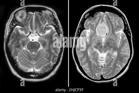 Sur la gauche se trouve une IRM (vue axiale pondérée à T2°) du cerveau normal d'une femme de 54 ans.Sur la droite se trouve une IRM axiale montrant l'apparence typique d'un méningiome à gorge olfactive.Les méningiomes sont des tumeurs bénignes provenant de la couverture du cerveau.Ces derniers ont généralement un bon pronostic. Banque D'Images