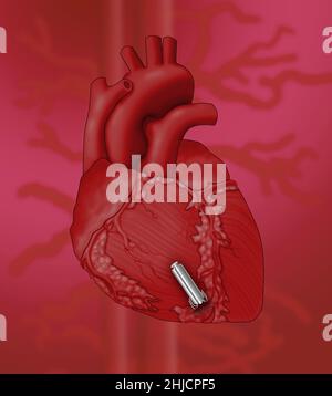 Image conceptuelle d'un stimulateur cardiaque sans plomb.Il est beaucoup plus petit qu'un stimulateur cardiaque traditionnel et n'avait pas de fils entre le stimulateur cardiaque et le cœur.Il est placé dans le cœur lui-même par une veine de la jambe, dans le ventricule droit. Banque D'Images