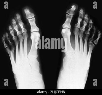 Rayons X des pieds, montrant polydactylie postaxiale. Le polydactylisme est l'anomalie congénitale d'avoir des doigts ou des orteils étrangers. Comme visible ci-dessus, cet individu avait six orteils sur les deux pieds. C'est un exemple de polydactylie postaxiale, parce que le chiffre supplémentaire se trouve sur le côté piquant du pied. Banque D'Images