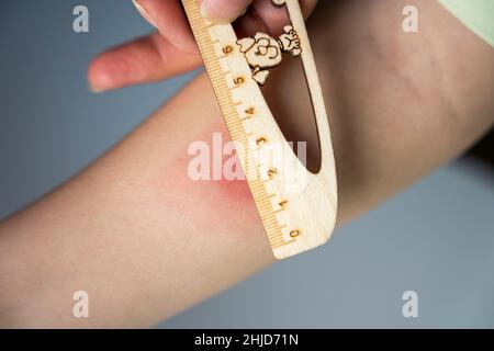 Mesure de la tache rouge sur le bras avec une règle après la vaccination de mantoux. Réaction au test de Mantoux. Banque D'Images