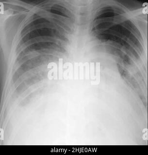 Hypertrophie cardiaque et oedème pulmonaire, radiographie Banque D'Images