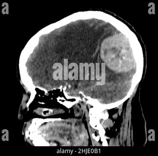 Méningiome, TDM Banque D'Images