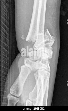Fracture des colles, rayons X. Banque D'Images