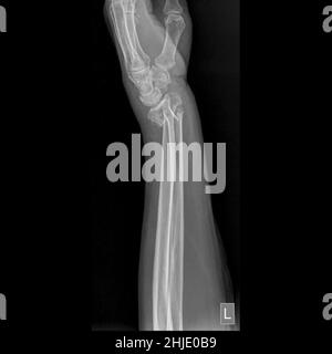 Fracture des colles, rayons X. Banque D'Images