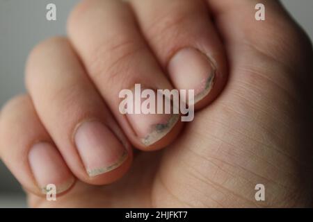 clou endommagé sans manucure avec gros plan de la saleté.Soins de santé des ongles. Banque D'Images