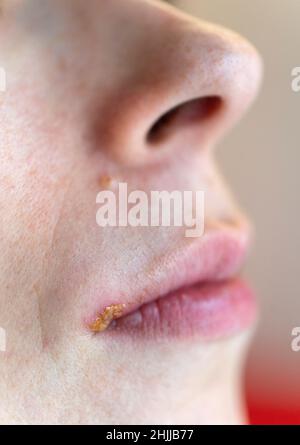 Femme avec le virus de l'herpès simplex sur sa lèvre supérieure Banque D'Images