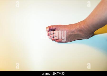 Vue rapprochée du pied femelle avec gros orteil endommagé.Accidents, santé et assurance. Banque D'Images